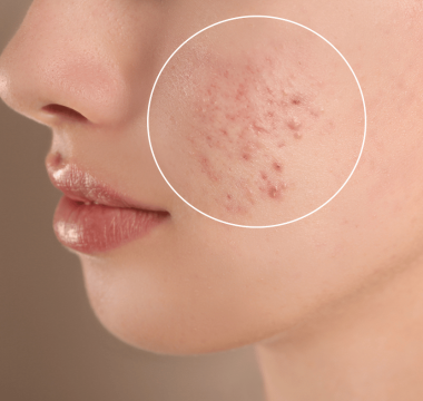 rejuvenecimiento parpados con laser (16)